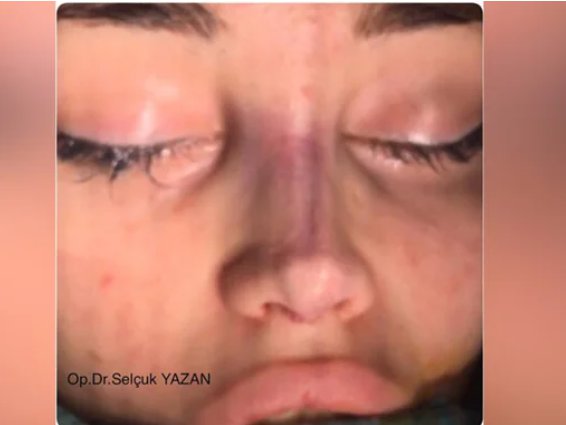 Anđela završila kod hirurga Ane Korać! Turčin od bivše zadrugarke napravio ŽIVU BARBIKU, a onda je na red došla i Đuričićeva: Evo koliko je platila operaciju nosa, NIJE JOJ PRVA?!