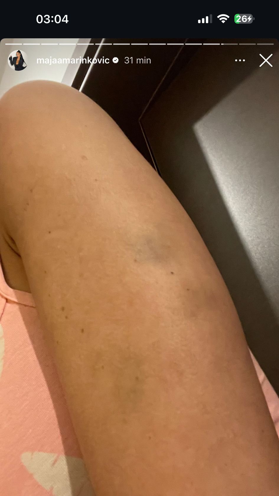Pretučena Maja Marinković! Sva krvava i u modricama, za nasilje optužila Filipa Cara: Gurao mi je pištolj u usta, zabijao nož iznad glave (UZNEMIRUJUĆE FOTOGRAFIJE)
