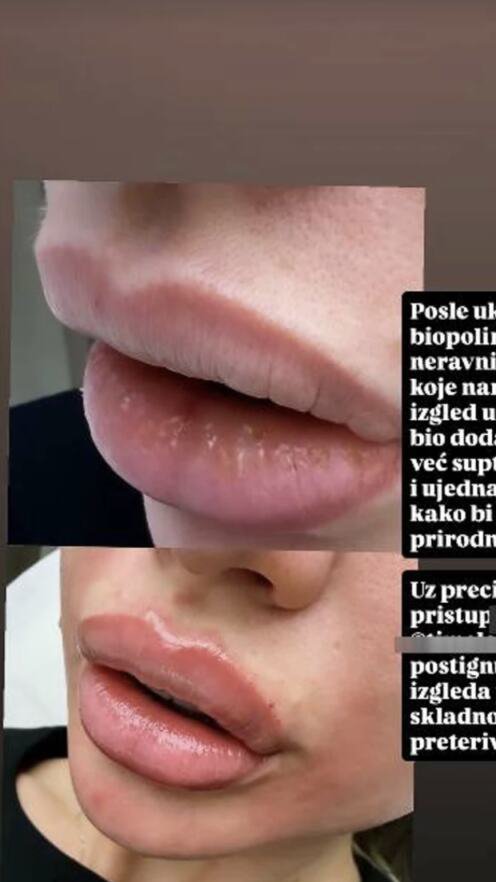 Milica Kemez izvadila biopolimer iz usana: Pogledajte kako sada izgleda, razlika je očigledna (FOTO)