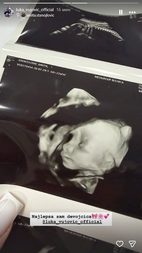 Budući roditelji podelili radosne vesti! Anita Stanojlović i Luka Vujović objavili sliku s ultrazvuka i potpuno raznežili fanove: Najlepša sam devojčica... (FOTO)