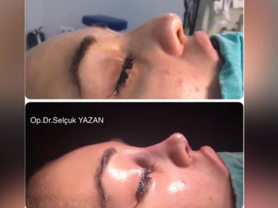 Anđela završila kod hirurga Ane Korać! Turčin od bivše zadrugarke napravio ŽIVU BARBIKU, a onda je na red došla i Đuričićeva: Evo koliko je platila operaciju nosa, NIJE JOJ PRVA?!